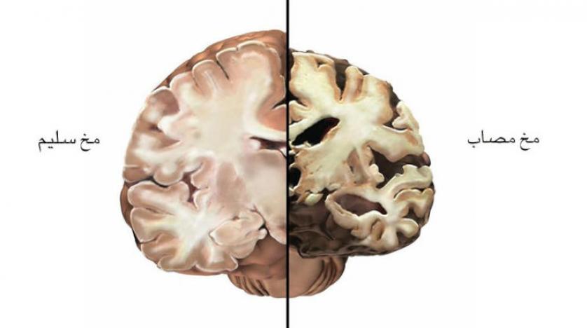 Bilim insanlarından Alzheimer hastalarına müjdeli haber